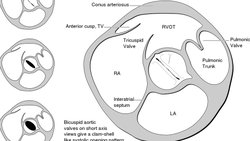 Biküspit Aort Kapak