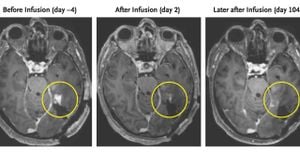 New Imaging Workflow Enhances Glioma Diagnosis Accuracy