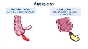 New Insights Into Phlegmonous Appendicitis Classification