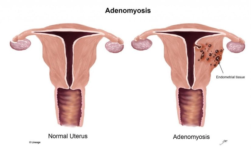 Adenomyozis tedavisi